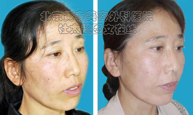 消除和减缓鱼尾纹的三个方法