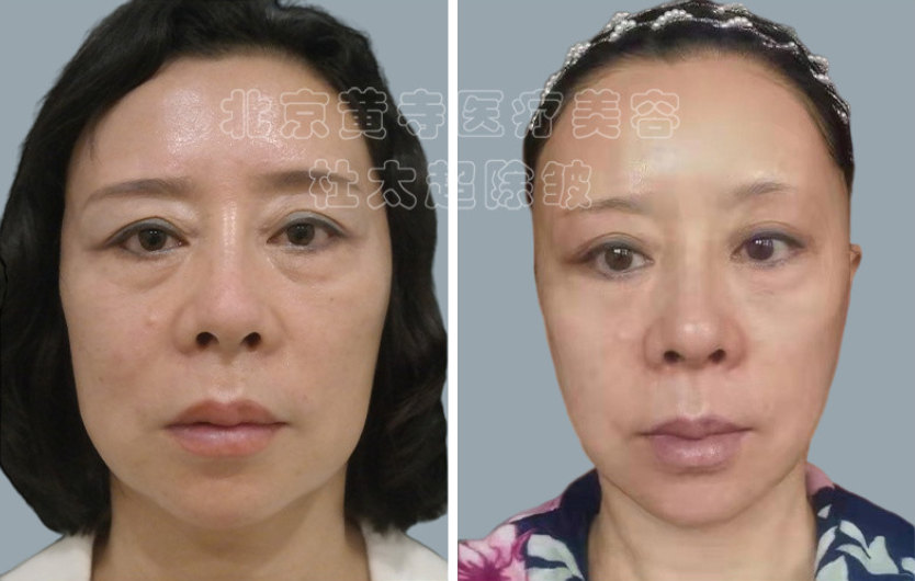 面部提升术有几种方法