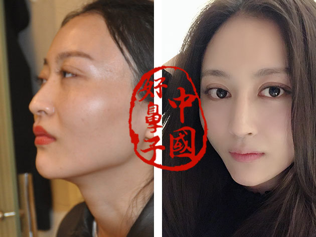 暑期鼻整形需要注意的那些事项! 暑期鼻整形需要注意的那些事项!