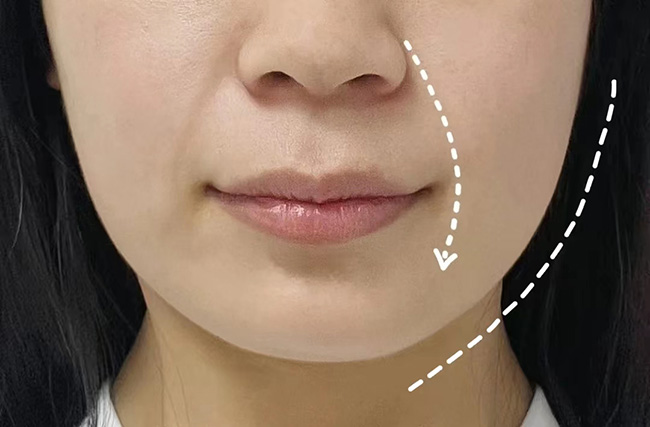 小切口拉皮手术的适应年龄段？