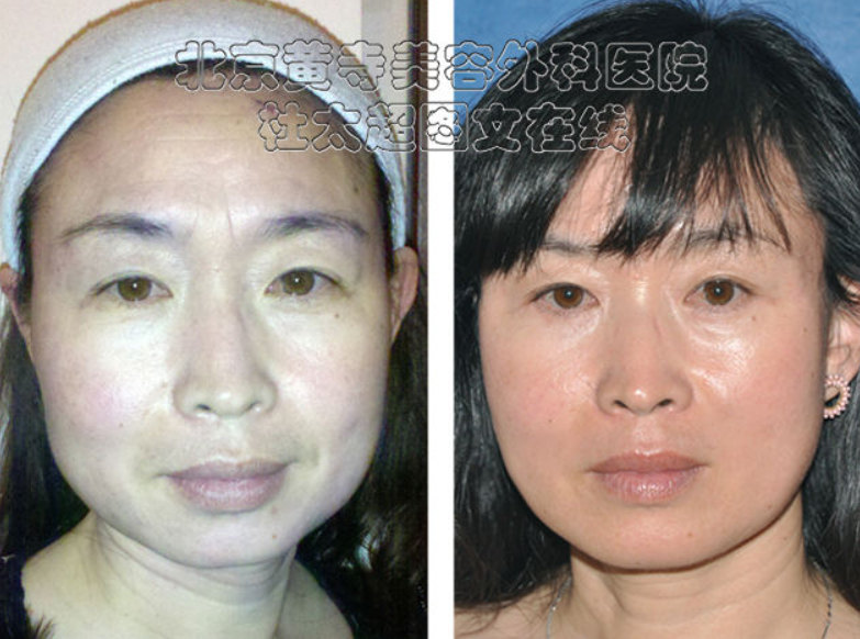 川字纹除皱术后的注意事项