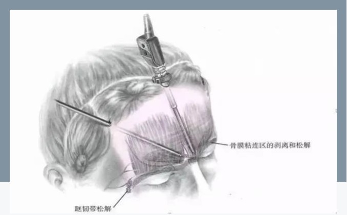 惊现“忧思纹”，让我如何解忧！
