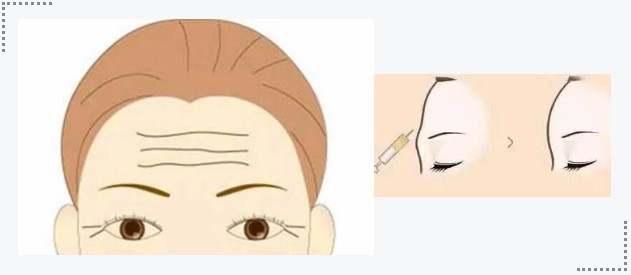 惊现“忧思纹”，让我如何解忧！