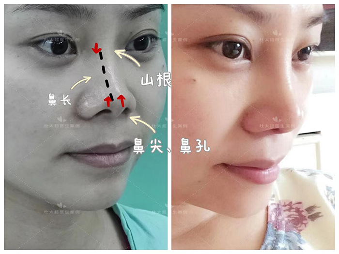 哪些是不符合鼻部美学标准的