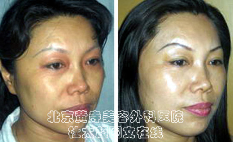 川字纹消除攻略