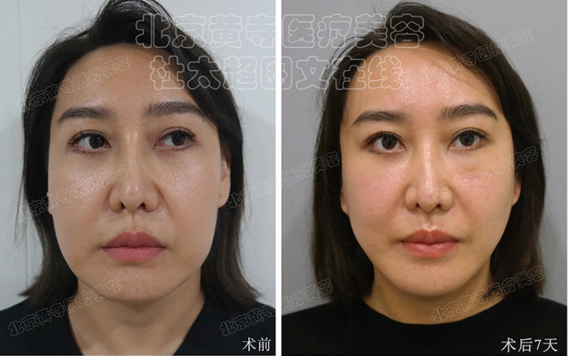 面部提升术的五大特点