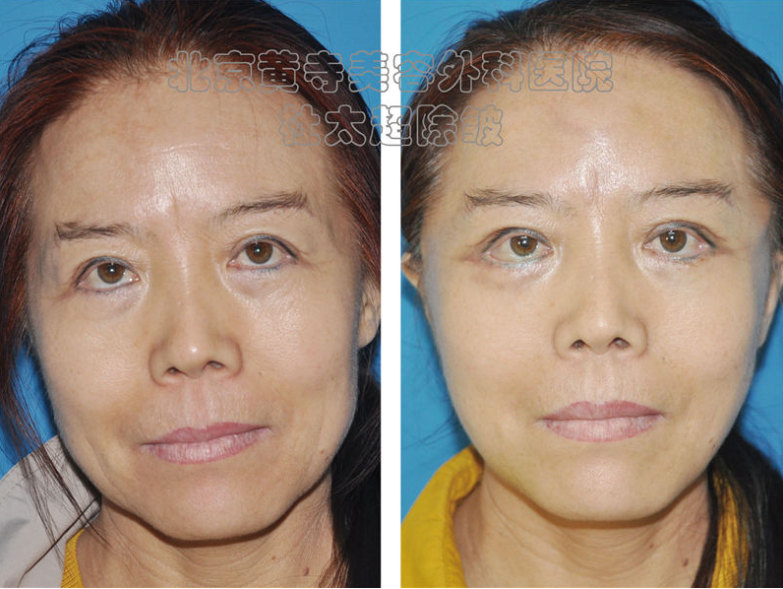 额纹祛除术效果怎么样