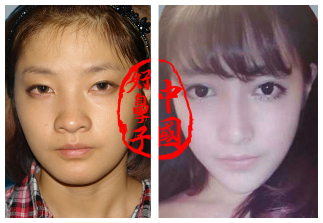 鼻综合整形（膨体隆鼻，耳软骨鼻尖， 鼻尖延长 )