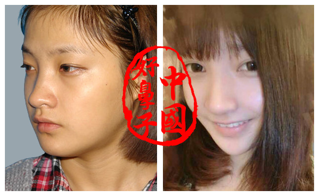 鼻综合整形（膨体隆鼻，耳软骨鼻尖， 鼻尖延长 )