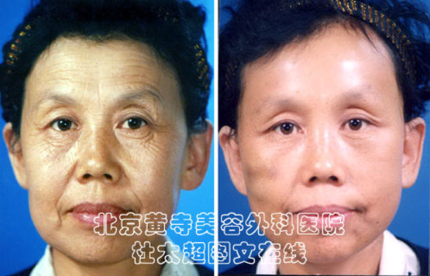 眼部除皱手术方法