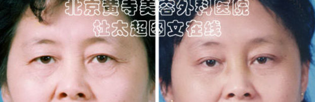 什么情况下人容易长眼部皱纹？