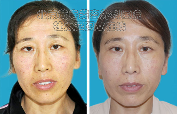 眼部除皱手术的注意事项