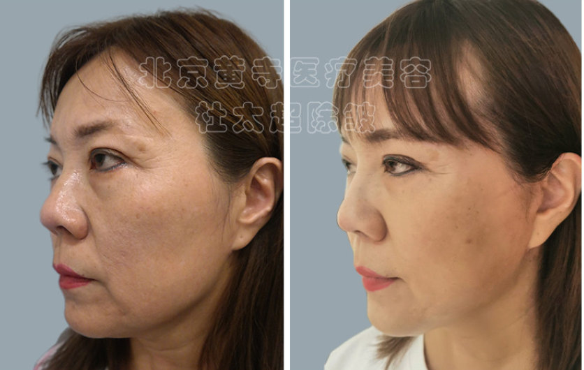 面部除皱术多久能消肿