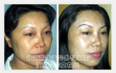 川字纹可以按摩消除吗