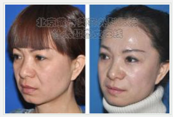 川字纹去除术效果怎么样