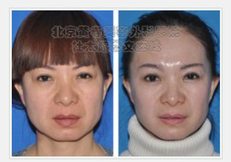 小切口面部提升术有效果吗