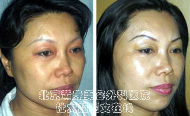 川字纹祛除术怎么样