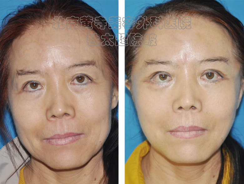 额头纹有什么办法消除呢