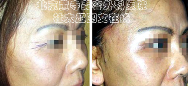 鱼尾纹除皱术效果怎么样