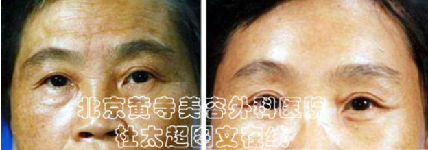 额纹祛除术术后注意事项