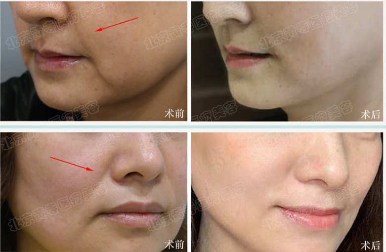 面部除皱术有哪些