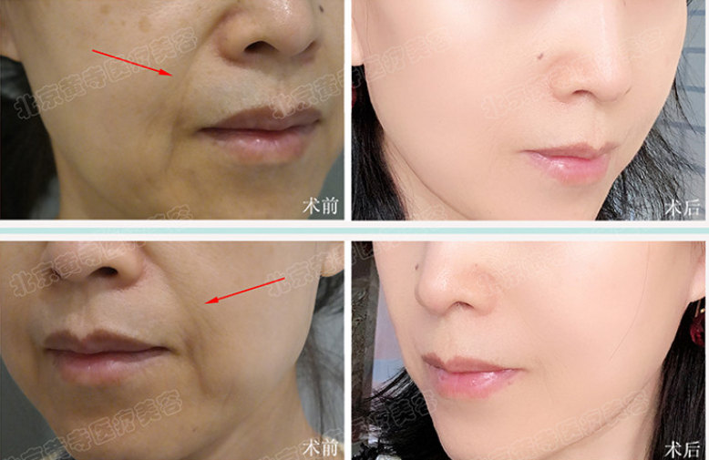 面部除皱术是什么