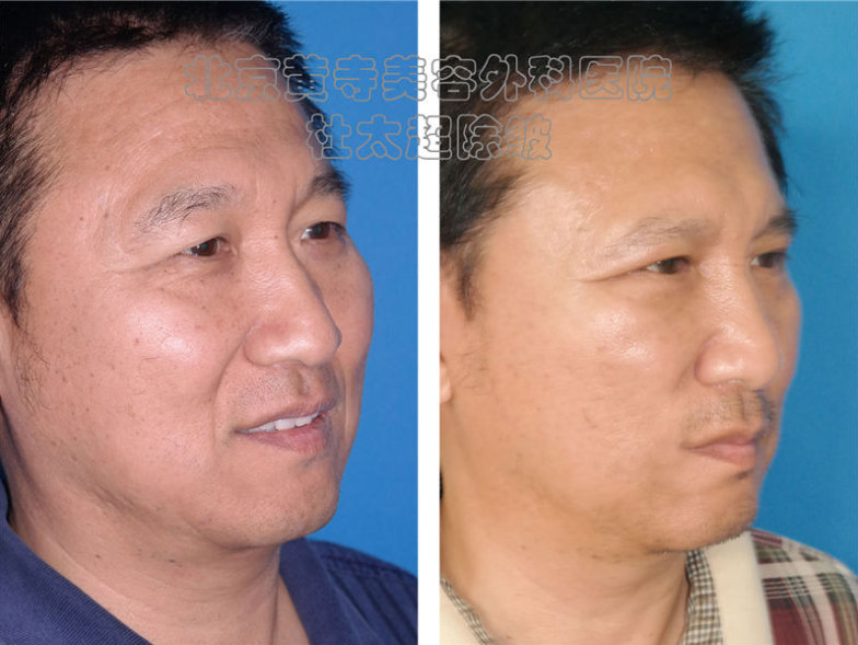 祛除川字纹的有效办法