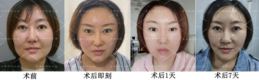 进行面部除皱手术要注意哪些问题