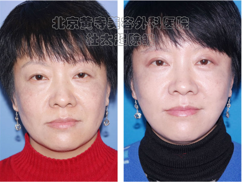 祛除眼部皱纹的方法