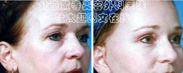 鱼尾纹怎么改善