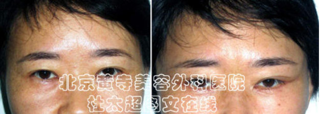 去除额头纹的方法