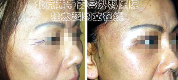 如何去除鱼尾纹