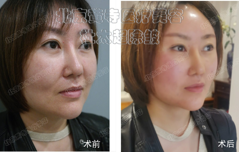 面部除皱术后多久能消肿