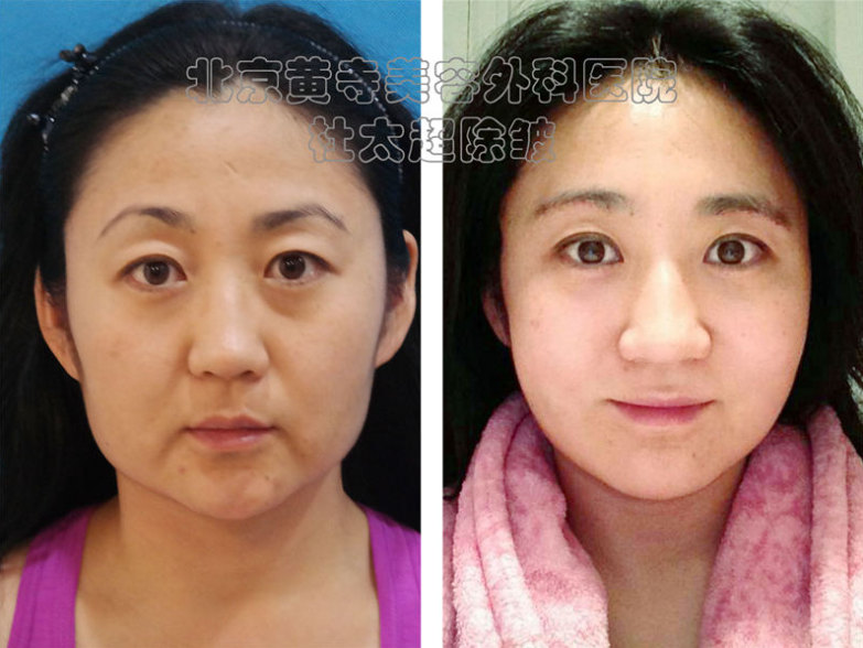 眼部去皱的方法有哪些