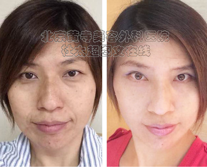 小切口面部提升术需要注意什么