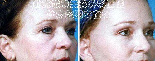 去鱼尾纹的方法