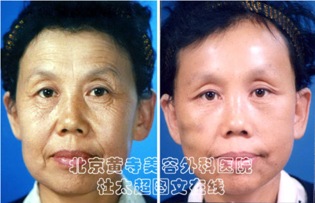 如何去除眼角鱼尾纹