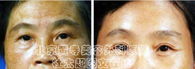 额纹是怎么产生的