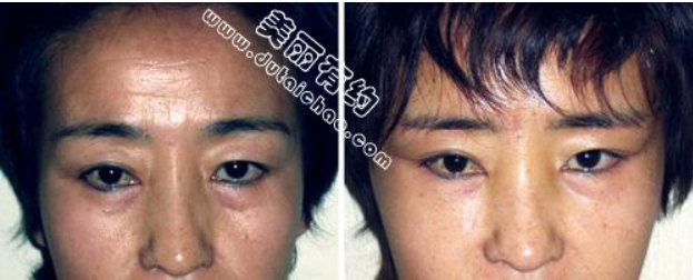 川字眉的形成是什么原因