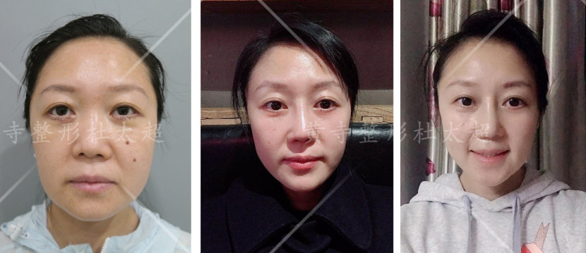 面部年轻化术前要注意什么