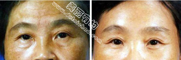 川字纹能用什么办法去除