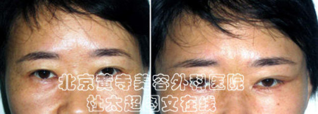 额纹祛除术的术前准备及术后护理