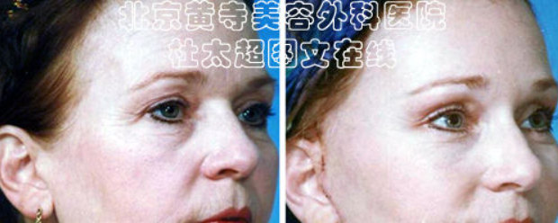 鱼尾纹出现的原因