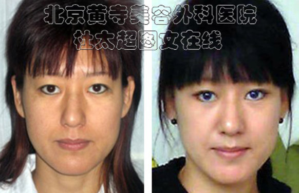 中下部面部提升术的方法