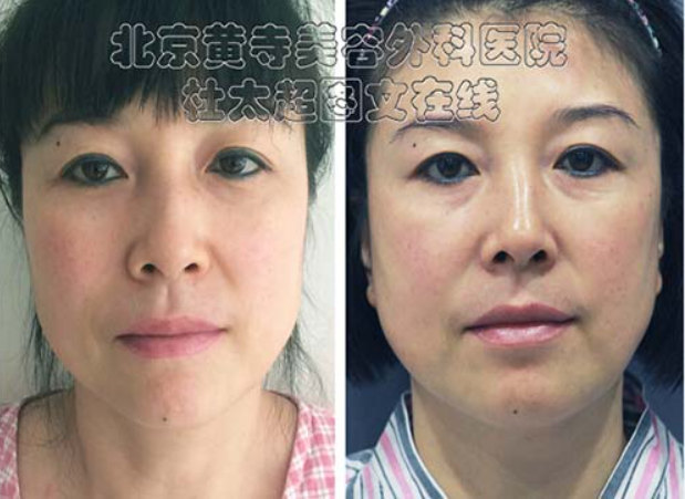 小切口面部提升术能维持多久