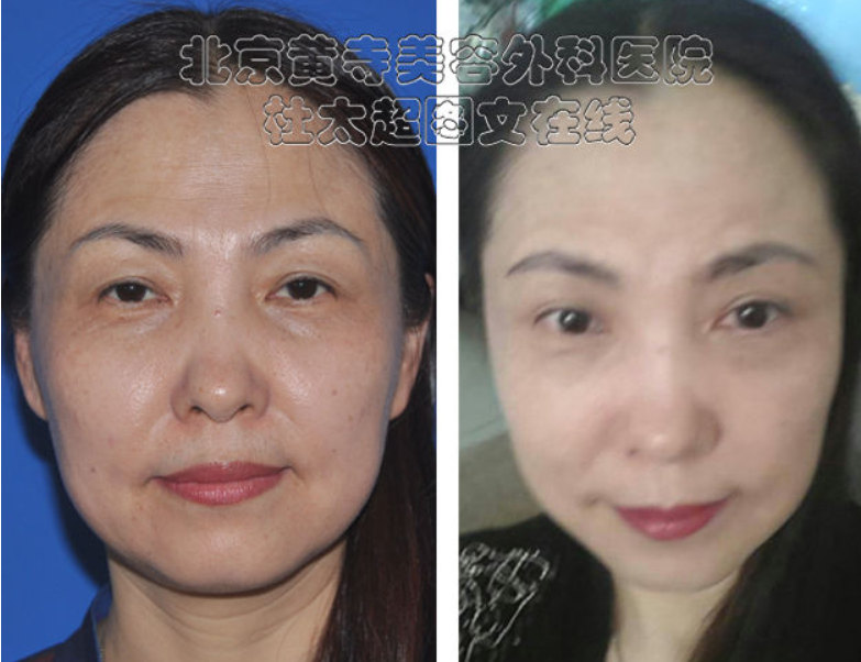 额纹去皱的方法