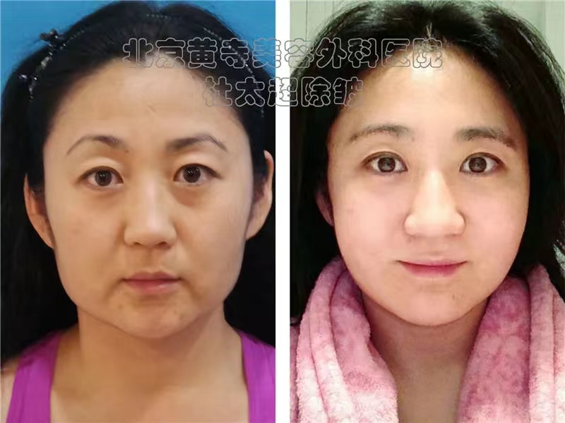 切眉可以解决那些衰老问题呢？