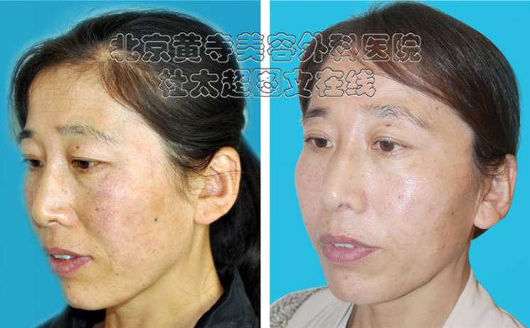 鱼尾纹的形成原因