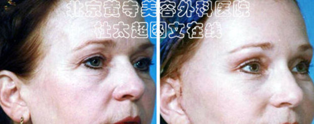 鱼尾纹的预防措施