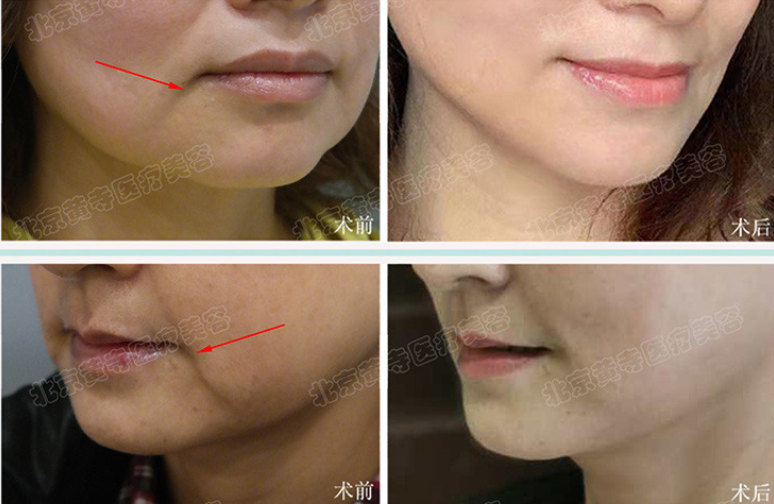 面部除皱术的术前准备